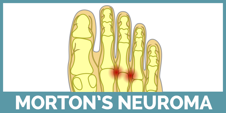 Learn about Morton's Neuroma with our guides