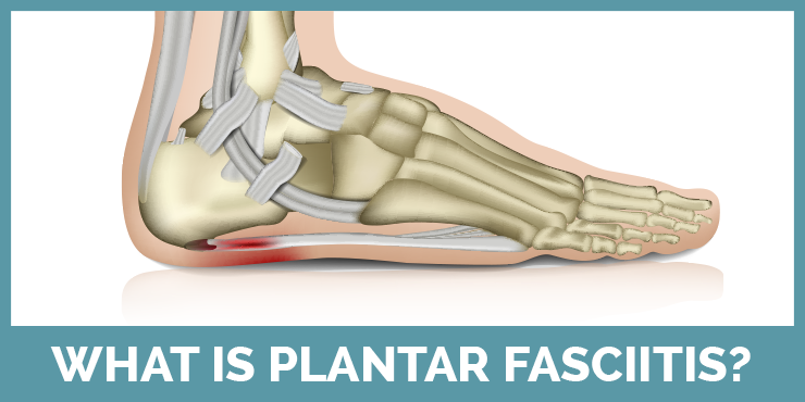 Learn about what plantar fasciitis is