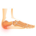 What are Calcaneal Spurs?