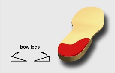 Prevent Bow Leg