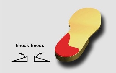 Knock Knee Prevention