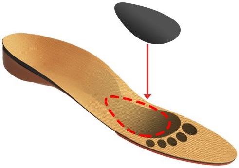 Proper metatarsal pad placement diagram