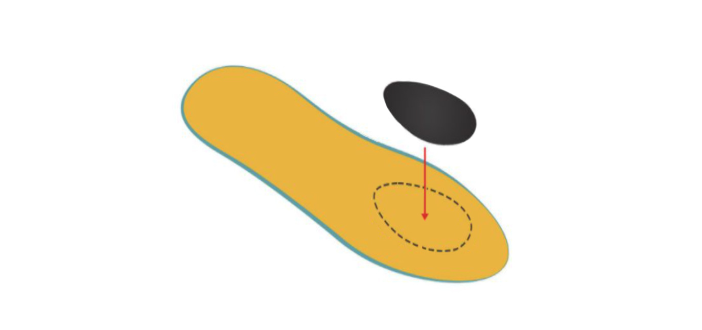 Proper metatarsal pad placement diagram