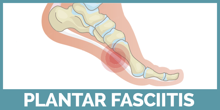 See Our Guides About Plantar Fasciitis