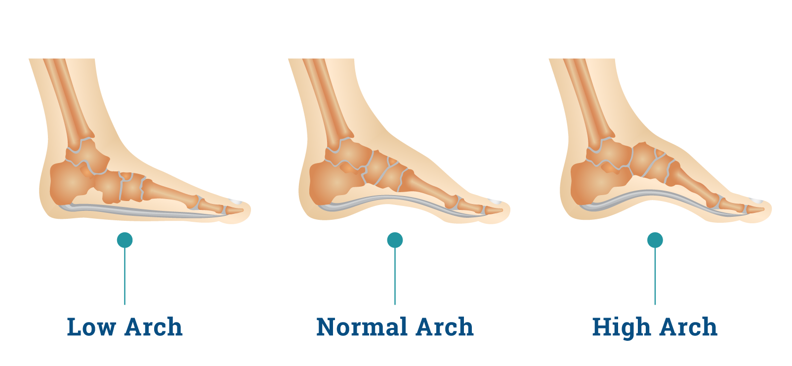 Types of Foot Arches