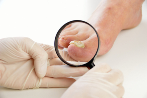 4 Common Foot Problems and Their Solutions