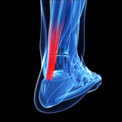 Learn How to Recover from Achilles Tendinitis