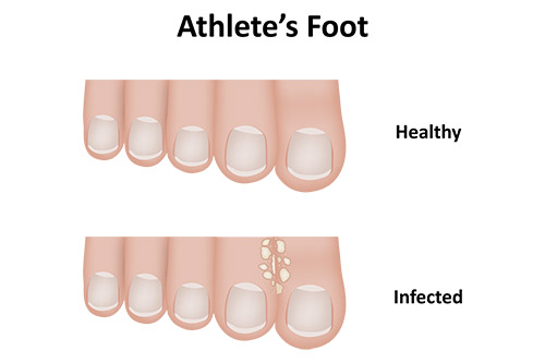 What is Athlete's Foot?
