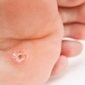 What are Calluses?