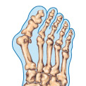 What is Hallux Valgus?