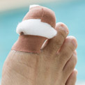 What are Ingrown Toenails?