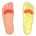 Best Insoles for Ball of Foot Pain