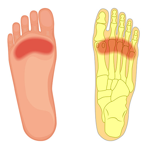 Best Insoles for Ball of Foot Pain 