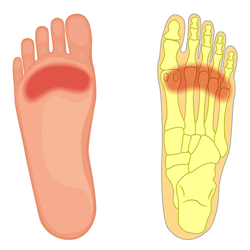 best running insoles for metatarsalgia