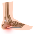 Causes of Plantar Fasciitis