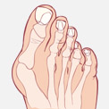 Treating Hallux Rigidus