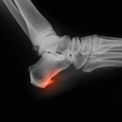 What are Bone Spurs?