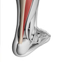 What is Achilles Tendinitis?