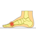 What is Hallux Limitus?