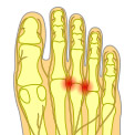 What Is Morton's Neuroma?