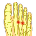 What Is Morton's Neuroma?
