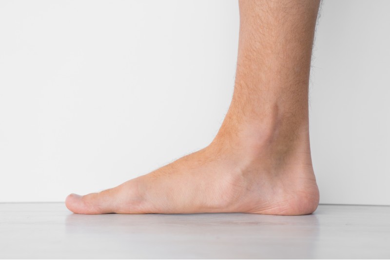 Flat foot image