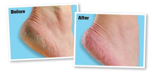 O'Keeffe's Healthy Feet Foot Cream was applied twice daily for two weeks Foot Cream Feet Before and After