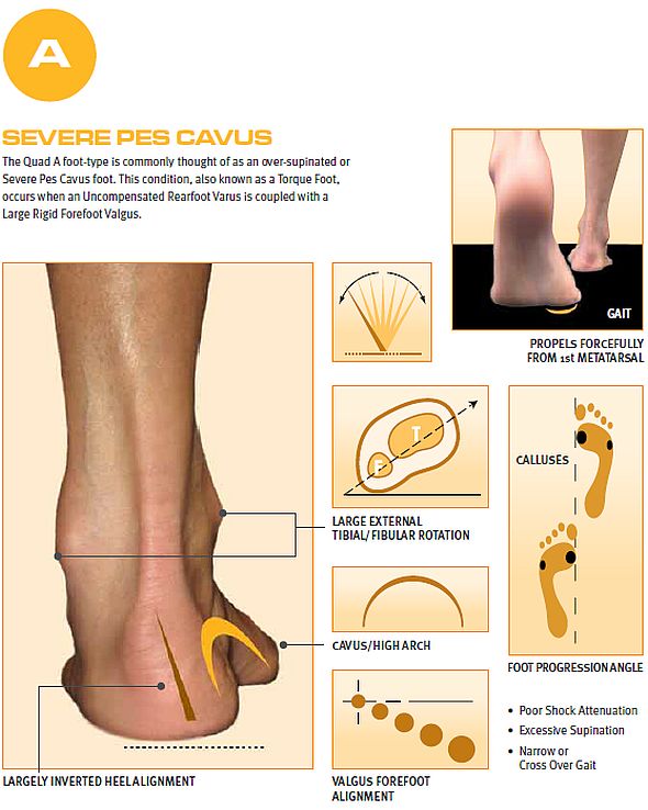 Over Supination Orthotic Insoles 